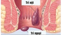 Cách chữa trĩ nội tại nhà an toàn, hiệu quả